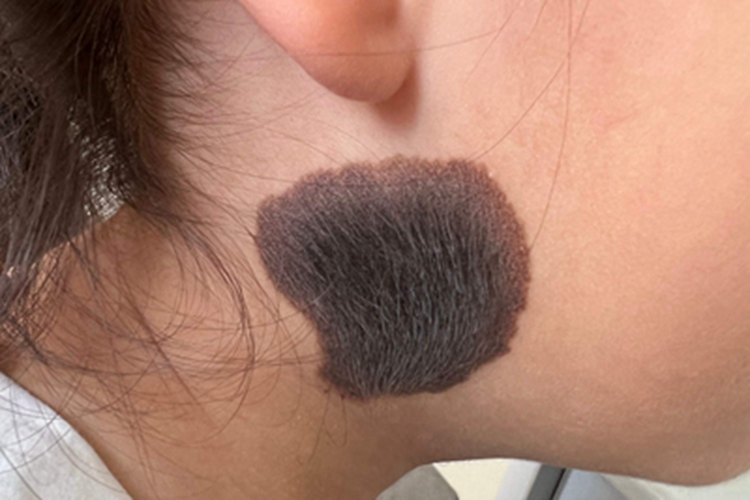 黑素细胞痣侧颈症状图 黑素细胞痣侧颈症状图