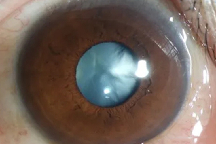 外伤性白内障瞳孔混浊图 外伤性白内障瞳孔混浊图