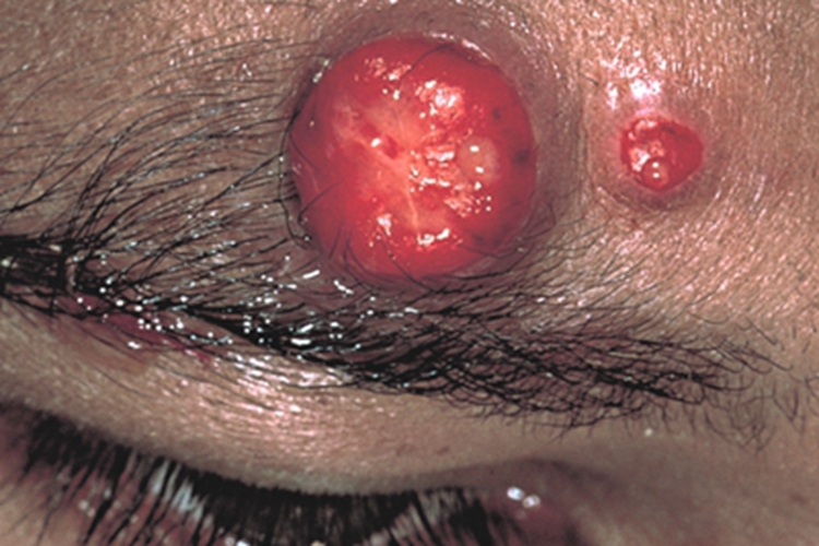 杆菌性血管瘤病症状图 杆菌性血管瘤病症状图