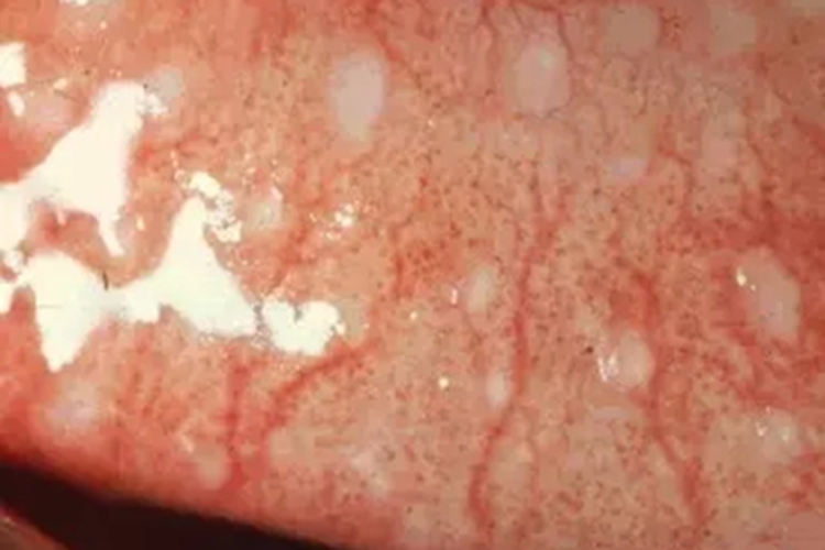 流行性角结膜炎结膜有血丝图 流行性角结膜炎结膜有血丝图