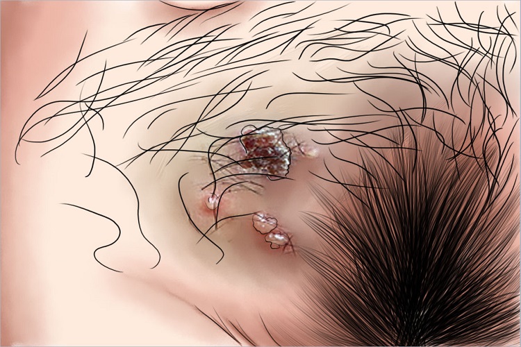 女性生殖器疱疹结痂手绘图