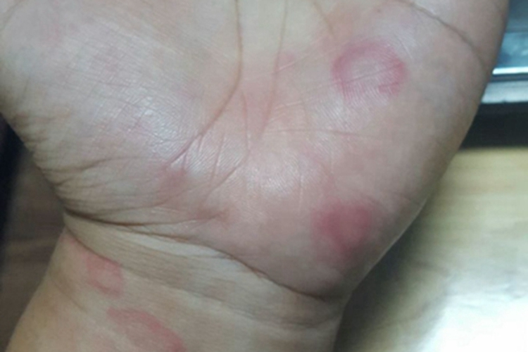 离心性环状红斑图