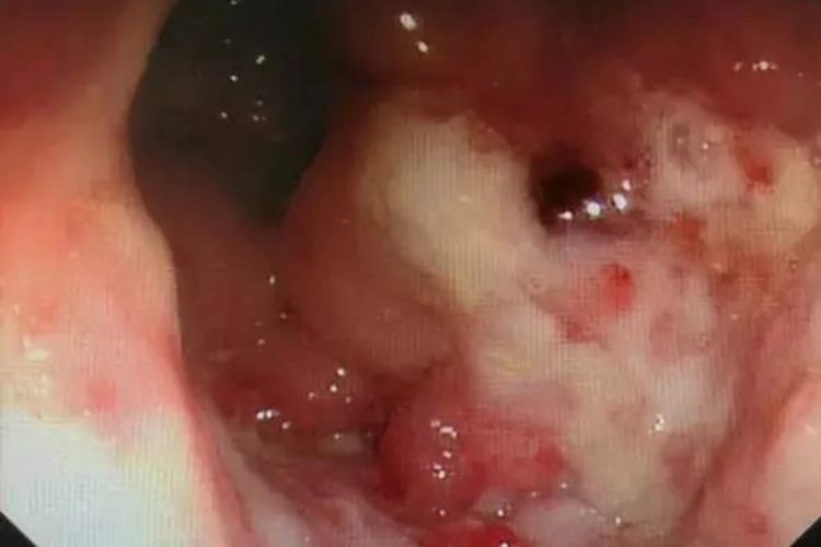 溃疡型肠结核肠镜检查图