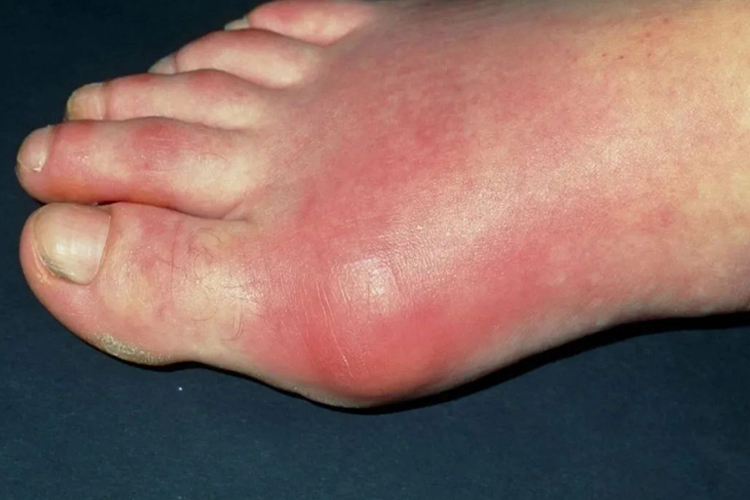 痛风性关节炎图 痛风性关节炎图