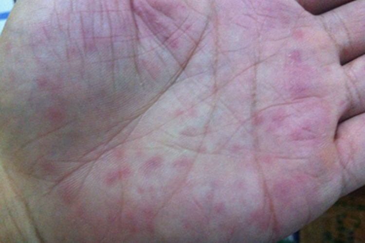 1级手足综合征手掌红斑图