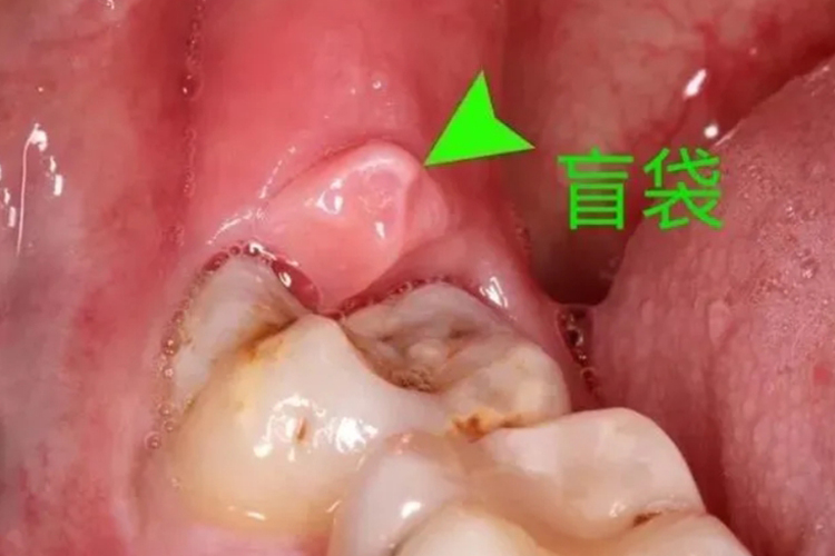 智齿冠周炎盲袋红肿图