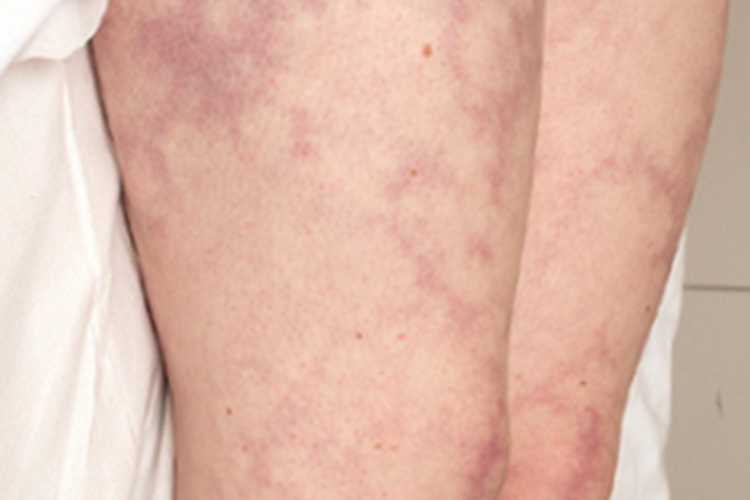 儿童结节性多动脉炎大腿条纹图