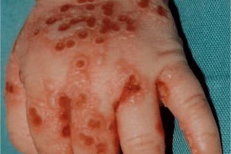 疱疹样天疱疮手背症状图 疱疹样天疱疮手背症状图