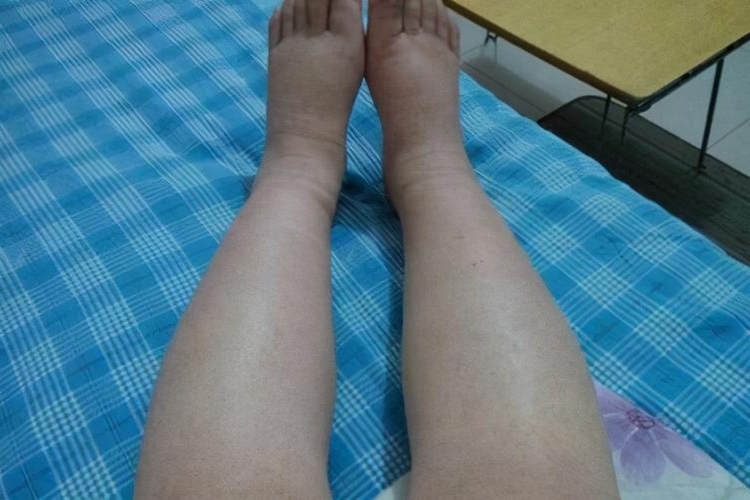 肝腹水早期下肢水肿图