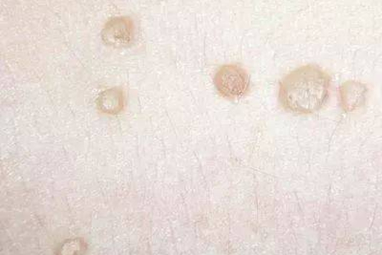 扁平疣脱落褐色萎缩图