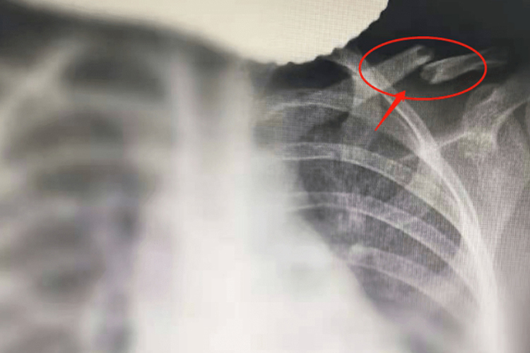 左锁骨骨折X线图 左锁骨骨折X线图