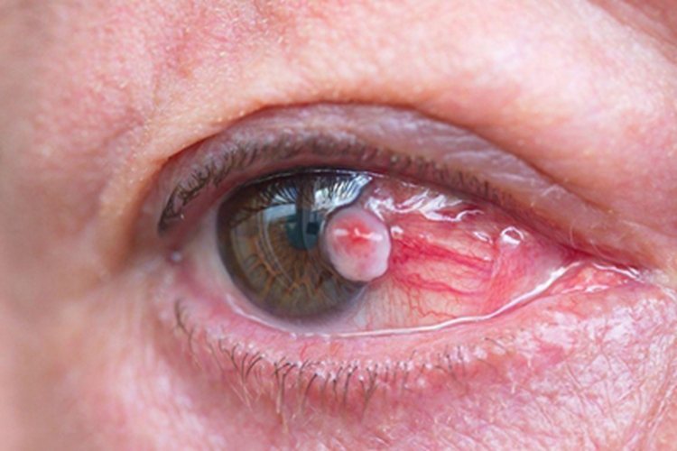 角膜鳞状上皮细胞癌眼球肉粒图