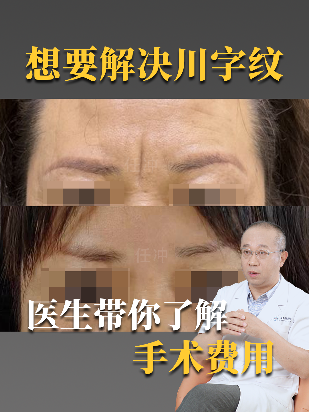 想要解决川字纹，医生带你了解手术费用