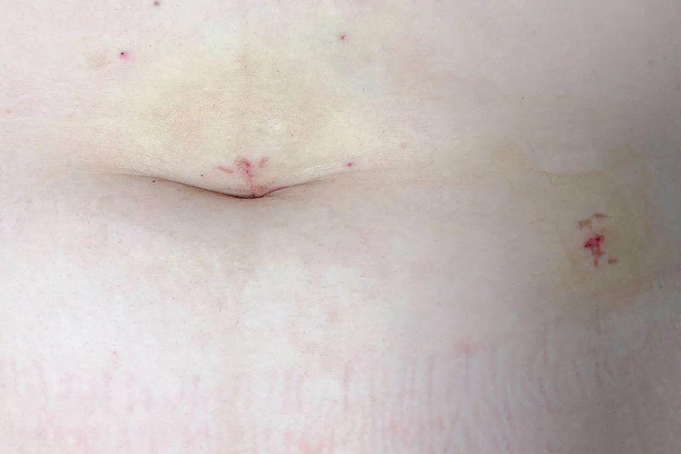 卵巢囊肿手术刀口图