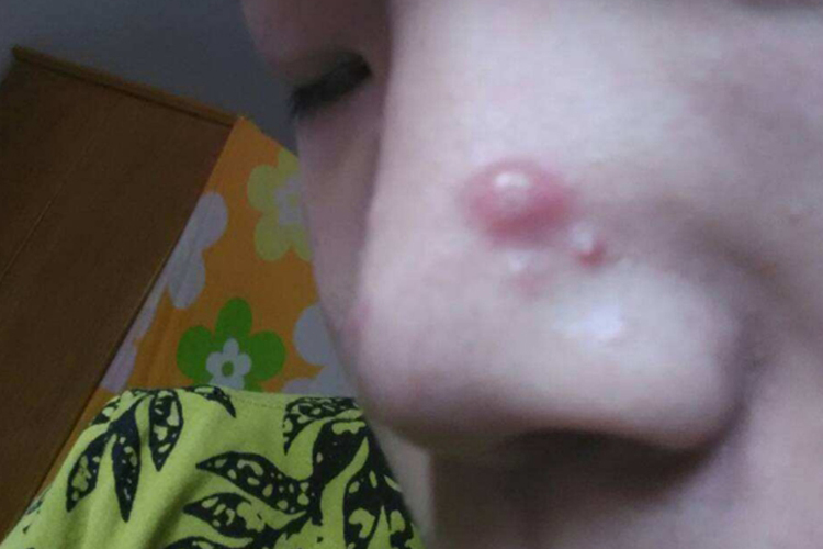 鼻子上有粉红色纤维瘤图 鼻子上有粉红色纤维瘤图