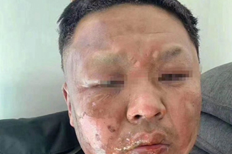 电烧伤面部变黑脱皮图