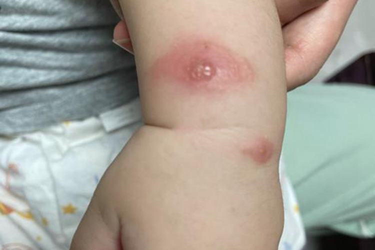 千足虫咬人伤口大疱图 千足虫咬人伤口大疱图