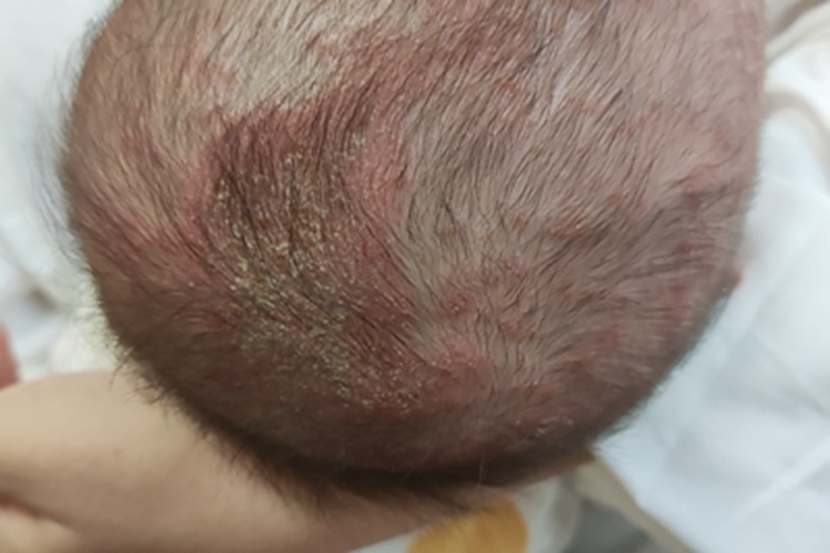 亚急性湿疹头皮结痂图 亚急性湿疹头皮结痂图