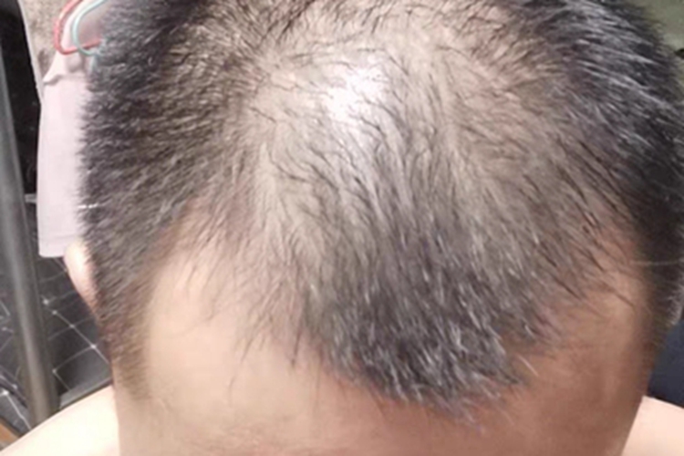 雄激素性脱发头上头发稀疏图
