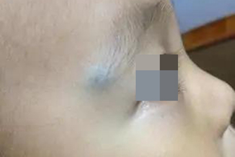 静脉畸形眉尾长青色小疙瘩图