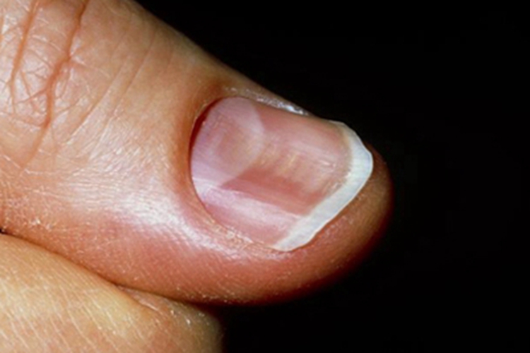 缺铁性贫血手指甲症状图