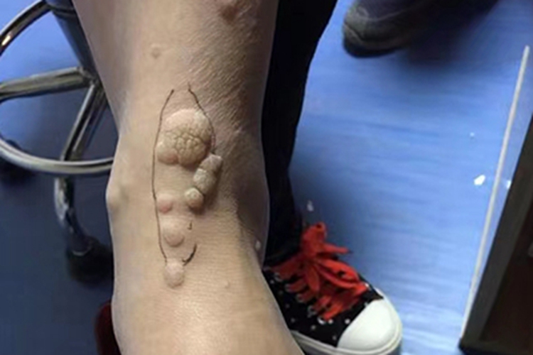 寻常疣脚踝裂纹图