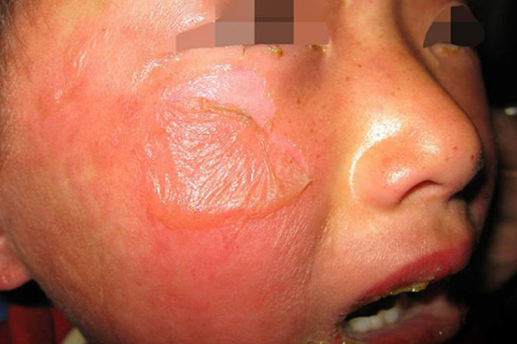 皮疹大疱渗出图