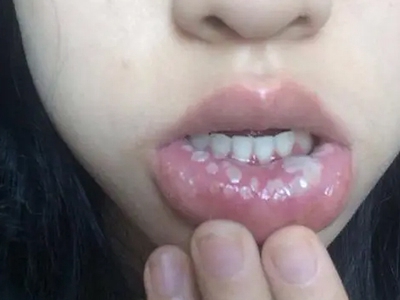 梅毒性唇下疳下嘴唇内有白色凸起图.jpg