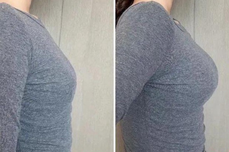 假体隆胸恢复后图