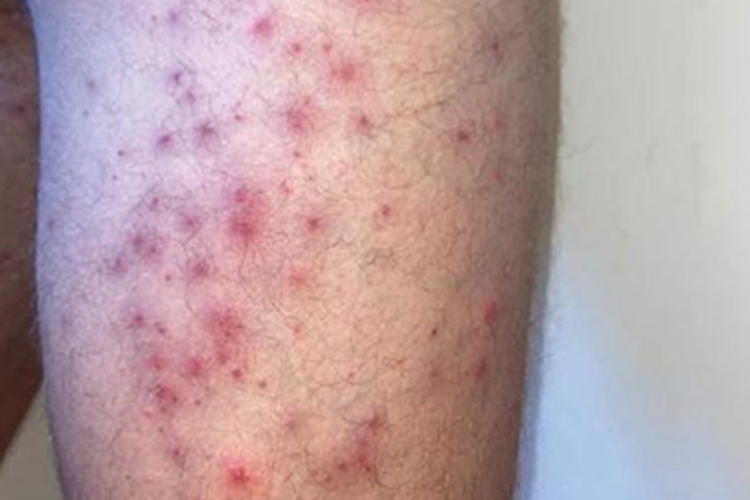 海水浴者皮疹大腿症状图