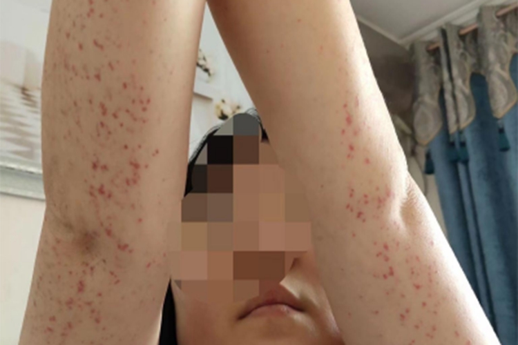 血栓性血小板减少性紫癜红点图 血栓性血小板减少性紫癜红点图