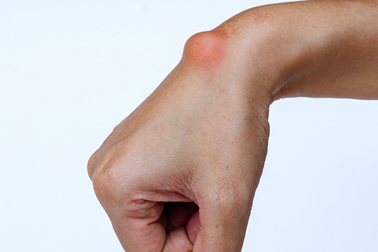 手腕腱鞘炎严重期图