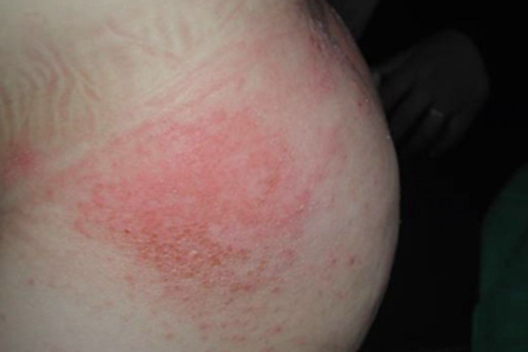 尿布皮炎症状图