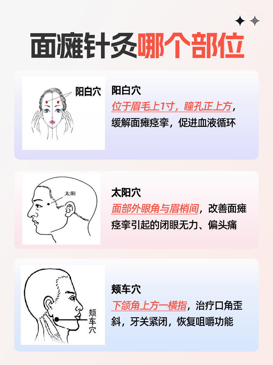面瘫针灸治疗，找准这些部位！