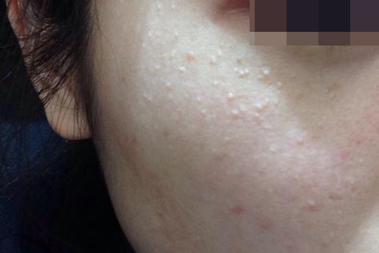 脸上籽籽样粟丘疹图