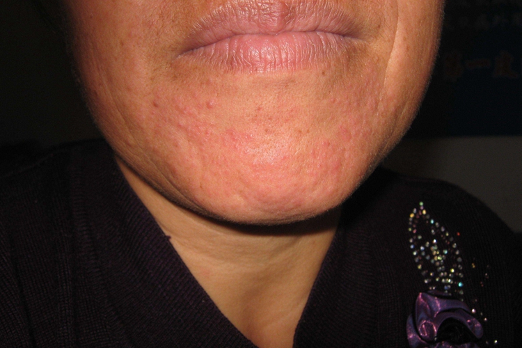 下嘴唇下边口周皮炎图