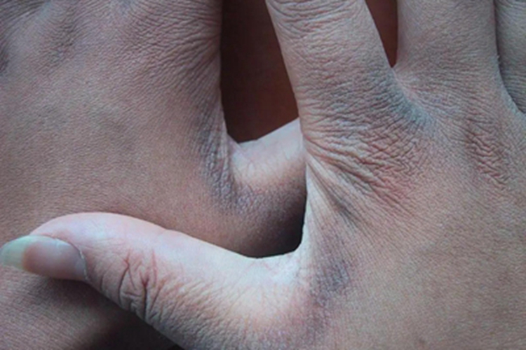 假性黑棘皮病手部症状图