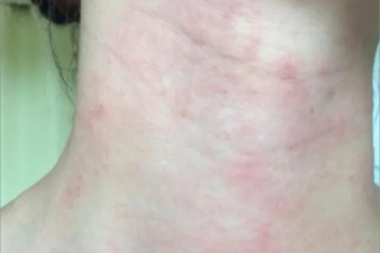 一氧化碳中毒发红图 一氧化碳中毒发红图