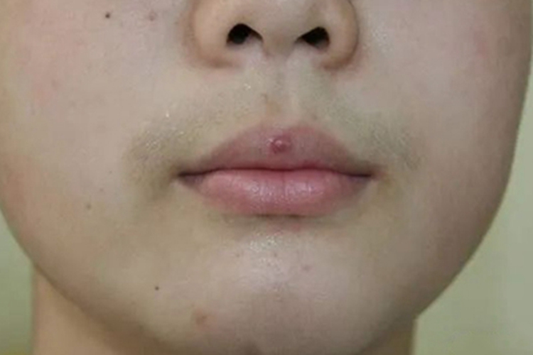 化脓性肉芽肿嘴唇疙瘩图