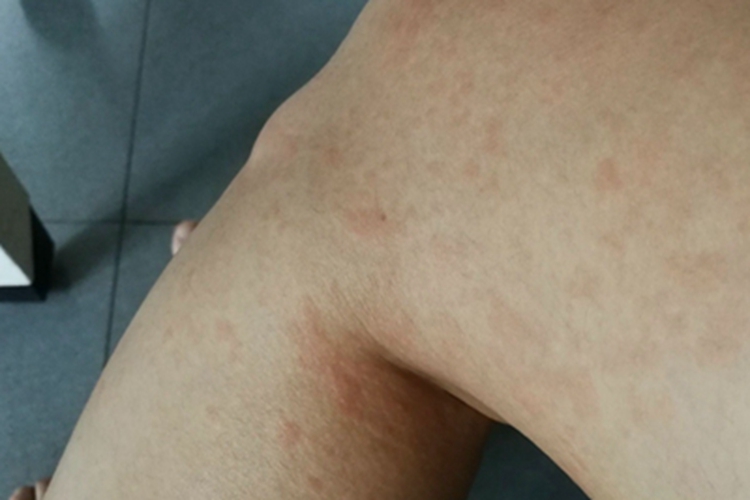 荨麻疹腿红点图