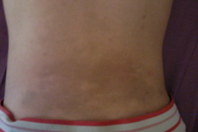 晒伤导致的女性后腰皮肤发黑图