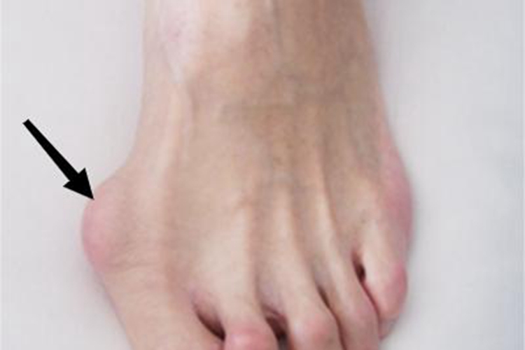 拇趾滑囊炎脚趾包块图 拇趾滑囊炎脚趾包块图