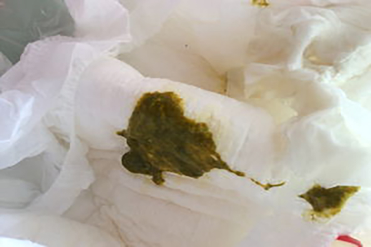 黄绿色大便图 黄绿色大便图