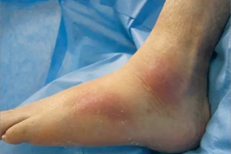 硬红斑脚背症状图