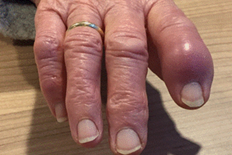 毛虫皮炎手指肿胀症状图 毛虫皮炎手指肿胀症状图