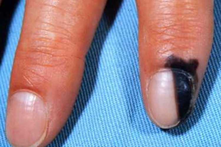 恶性黑色素瘤手指甲黑斑图