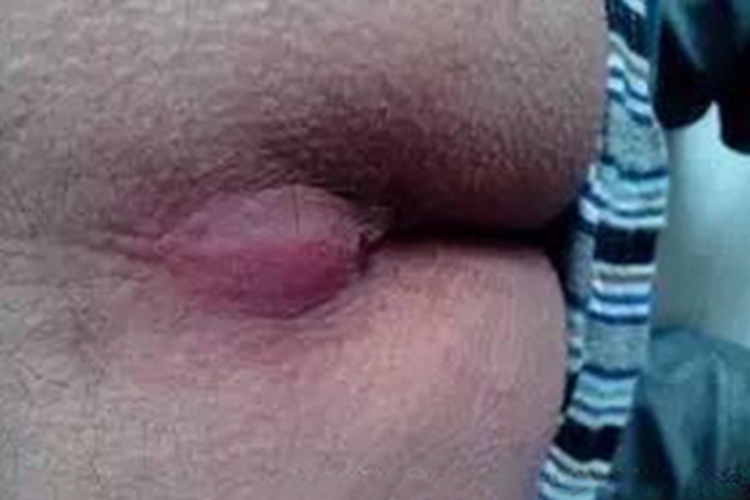 骶尾部藏毛窦皮肤长大包图 骶尾部藏毛窦皮肤长大包图