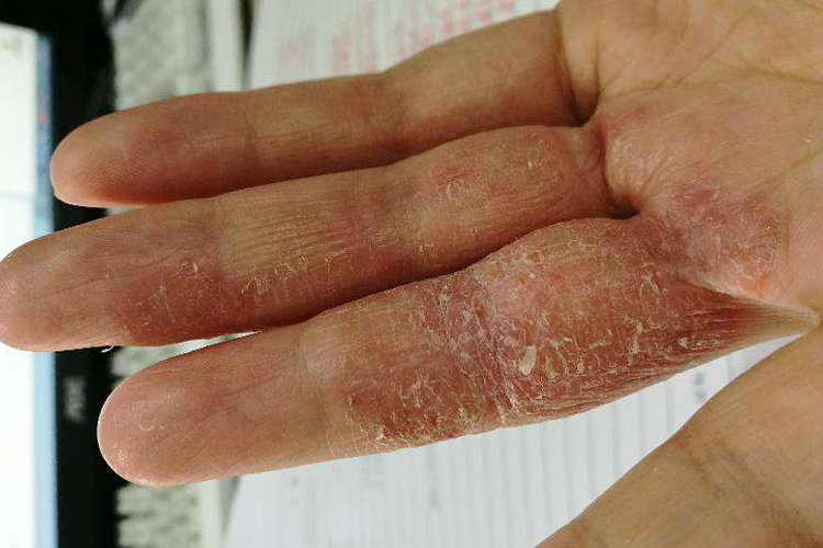 慢性湿疹图