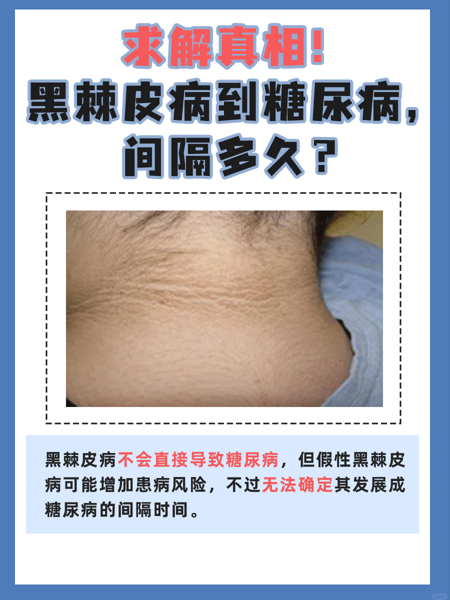求解真相！黑棘皮病到糖尿病，间隔多久？