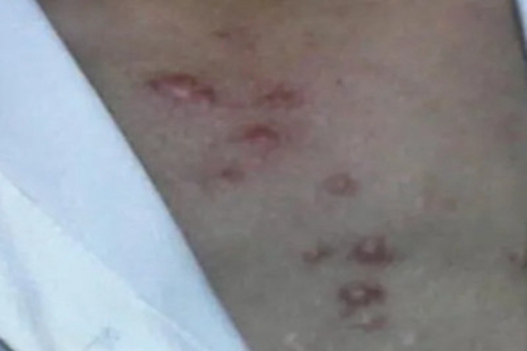 热带痤疮胸部有脓包图 热带痤疮胸部有脓包图